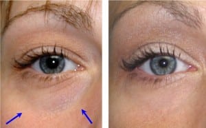 recapture your youth with a laser lower eyelid lift 5d5ea6e284c3b