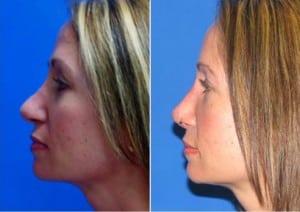 rhinoplasty revision how to correct a satisfactory nose job 5d5ea6cd59e9d