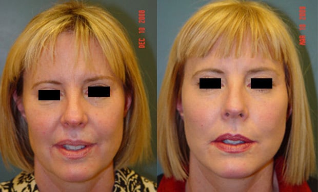 facelift surgery san francisco