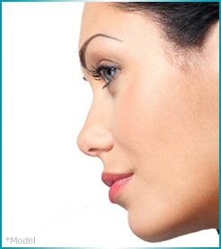 rhinoplasty