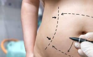 Doctor etches on patient's body to determine where to retrieve fat cells with liposuction.